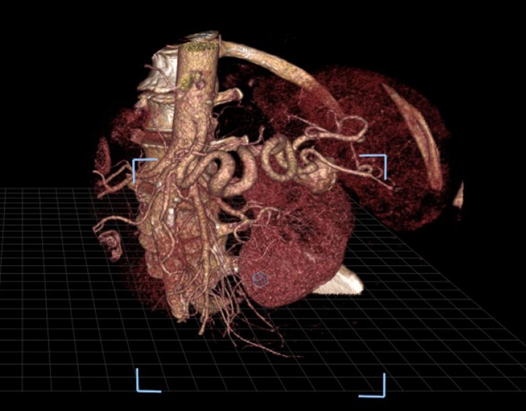 Imagen: Una imagen de un aneurisma de la arteria esplénica como se ve en la realidad virtual (Fotografía cortesía de SIR).